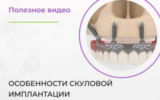 Особенности скуловой имплантации