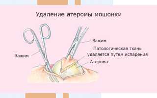 Почему образуется атерома машонки и как лечить недуг