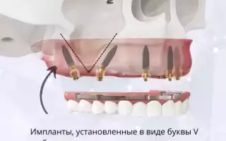 Имплантация V-II-V – передовое решение для восстановления всех зубов