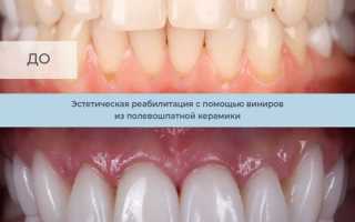 Полевошпатные виниры