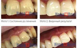 Световая пломба: как она выглядит и чем она лучше?