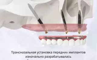 Транссинусальная имплантация – восстановление зубов на верхней челюсти без наращивания кости