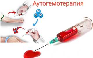 Аутогемотерапия: в чем польза процедуры