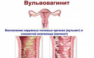 Атрофический вульвовагинит как предвестник угасания половой функции
