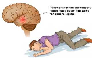 Височная эпилепсия