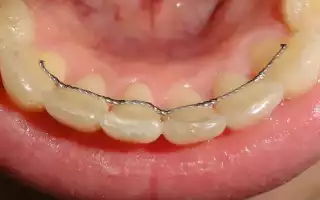 Что ставят после снятия брекетов? 