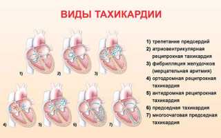 Виды современных операций от тахикардии