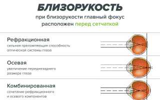 На что влияют и как определить степени близорукости