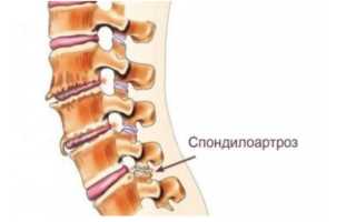 Как протекает спондилоартроз шейного отдела позвоночника