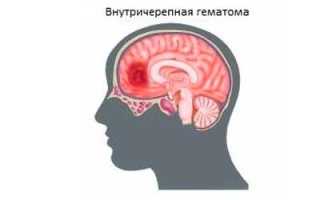 Внутричерепная гематома и ее последствия