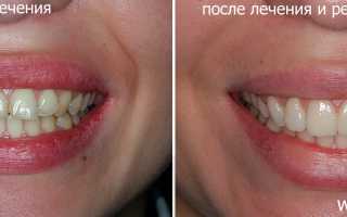 Виниры на передние зубы — создание красивой улыбки