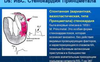 Как распознать и вылечить стенокардию Принцметала