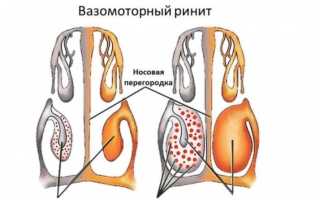 Помощь при нейровегетативном вазомоторном рините