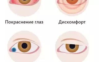 Безошибочно распознаем и лечим хламидийный конъюнктивит