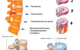Чем опасна секвестрированная грыжа позвоночника