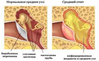 Спасаемся от острого гнойного среднего отита
