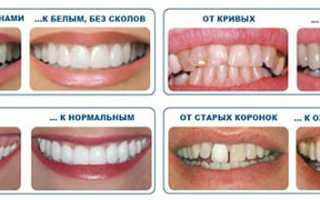 Реставрация зубов — эстетическое восстановление зубного ряда