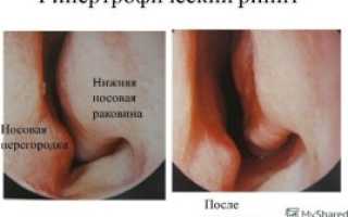 Чем вреден хронический гипертрофический ринит
