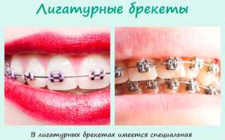 Керамические брекеты – плюсы и минусы