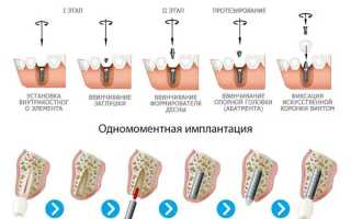 Этапы имплантации зубов