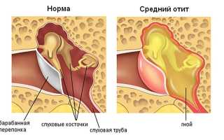Какие симптомы укажут на средний отит