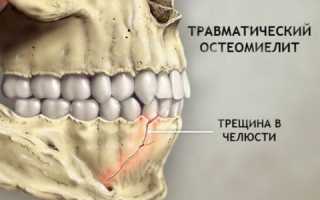 Остеомиелит челюсти: причины, симптомы, лечение