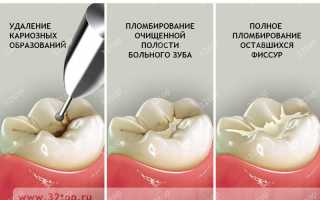 Фиссурный кариес: симптомы, лечение и профилактика