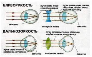 Сравнительные характеристики близорукости и дальнозоркости