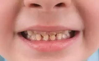 Что делать, если портятся молочные зубы