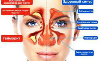 Как вовремя выявить острые риниты и синуситы