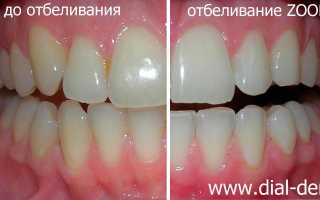 Методы отбеливания зубов после снятия брекетов