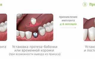 Где лучше сделать имплантацию зубов? Полезные советы по выбору