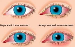 Проявления и схема лечения аллергического конъюнктивита