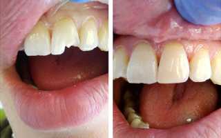 Возможно ли поставить пломбу на передний зуб?