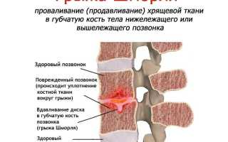 Что такое и чем опасна грыжа Шморля позвоночника