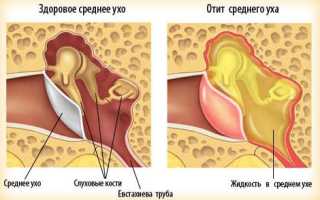 Что делать с назойливым экссудативным отитом