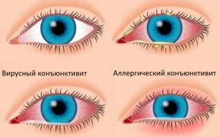 Как диагностировать и победить хронический конъюнктивит