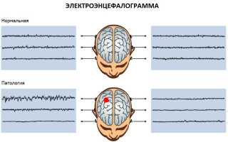 Парциальная эпилепсия