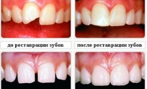 Фото: Реставрация коронок